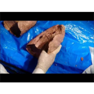 Left Pulmonary Surgical Anatomy - Sanjoy Sanyal