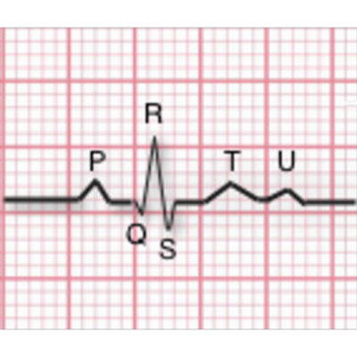 EKG Interpretation | Tutorials and Quizzes