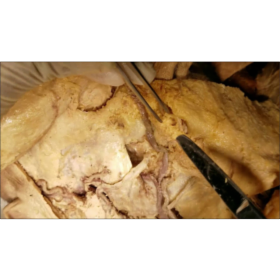 Facial Vessels Traced–Nosebleed–Danger Triangle–Cavernous Thrombosis–Horner Syndrome–Sanjoy Sanyal