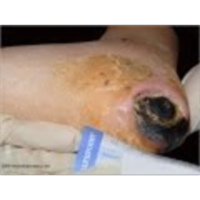 Pressure Ulcers & Pressure Ulcer Staging / Prevention