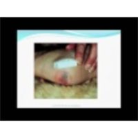 What are Pressure Ulcers or Bed Sores ? Alternating Air Mattress icon