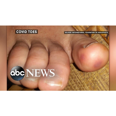 Doctors warn of mystery coronavirus symptom called 'COVID toes' icon
