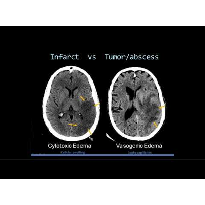 Intro to Head CT Part II: Evaluation of Ischemic Stroke icon
