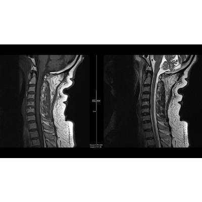Noncontrast MRI cervical spine search pattern icon
