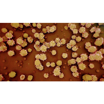 How is monkeypox treated? Dr. Sanjay Gupta explains - CNN Video icon