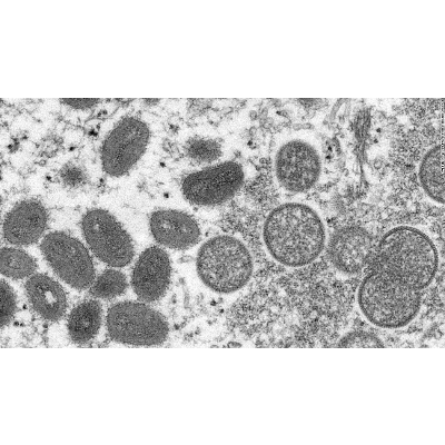 WHO describes what we know about Monkeypox virus transmission - CNN Video icon