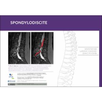 Spondylodiscite icon