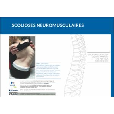 Scolioses neuromusculaires icon