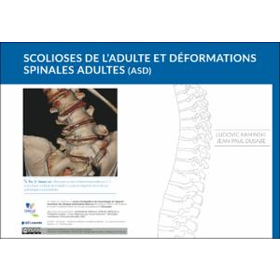 Scolioses de l’adulte et déformations spinales adultes (ASD) icon