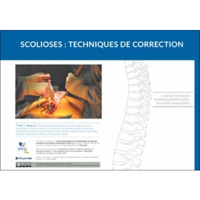 Scolioses : techniques de correction icon