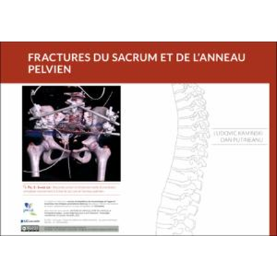 Les fractures du sacrum et de l’anneau pelvien icon
