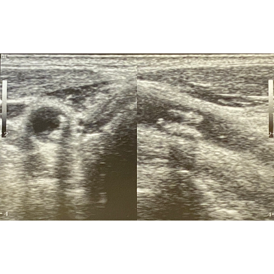 Understanding and Reducing Atherogenesis Plaque