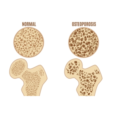 Osteoporosis icon