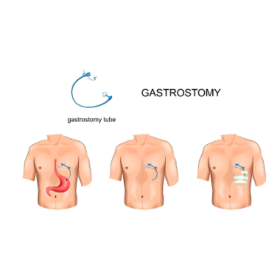 Pros and Cons of Feeding Tubes in Elderly | Caregiver Relief