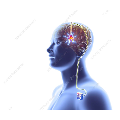 Implementing automation in deep brain stimulation: has the time come? icon