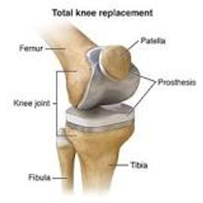 Total Knee Replacement: Summary