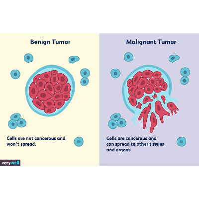 Differences Between a Malignant and Benign Tumor