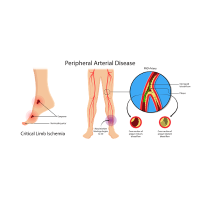 Peripheral Arterial Disease icon
