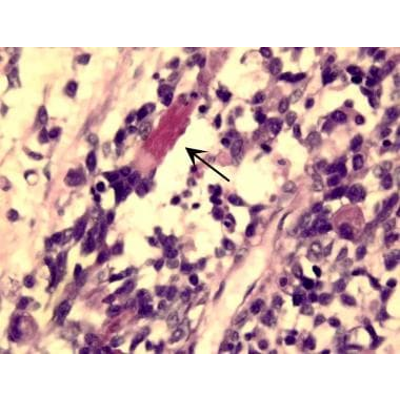 Pathology - Rhabdomyosarcoma: Practice Essentials, Histology, Presentation and Evaluation