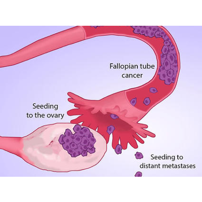 Ovarian Cancer Studies Aim to Reduce Racial Disparities icon
