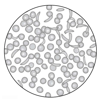 Activity for Sickle Cell: Natural Selection in Humans icon
